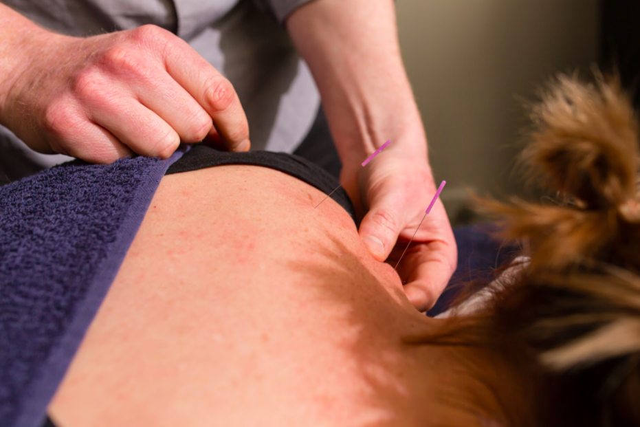 What we know about dry needling